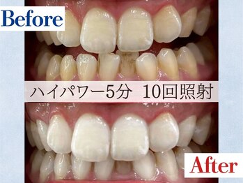 LBSホワイトニング 吉祥寺店/ホワイトニングビフォーアフター