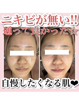 ホワイトアクア 天王寺本店(WHITE AQUA)/ハーブピーリング/毛穴洗浄/大阪