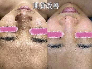 ルーチェ カリーノ(Luce Carino)の写真/毛穴・繰り返すニキビ・肌荒れに♪肌トラブルの原因に着目し、肌の土台から整える肌質改善