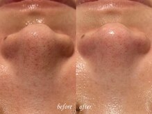 ティアラッシュ(TiaLash)/毛穴エクストラクション