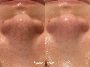 ティアラッシュ(TiaLash)/毛穴エクストラクション