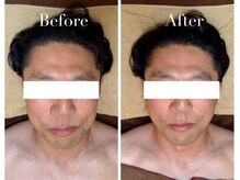 アブニールブリヨン/2BBioハーブピーリング/肌質改善