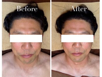 アブニールブリヨン/2BBioハーブピーリング/肌質改善