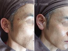 アート ビューティールーム(art beauty room)/☆光フェイシャル＆オーダー