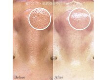 ピエル 北千住店(PIEL)/エクストラクション痛みについて