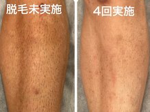 ヴィセラ(Vicella)/美肌脱毛