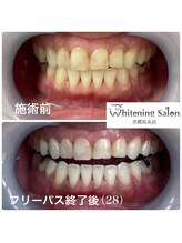 ホワイトニングサロン 京都烏丸店/ホワイトニング施術例