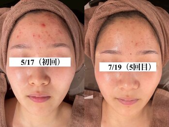 ハリト エステ(HaRi&)/毛穴洗浄/熊本/ハーブピーリング