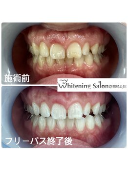 ホワイトニングサロン 京都烏丸店/ホワイトニング施術例
