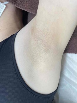 エルミューノ(elμno)/ワキ脱毛 ビフォー