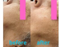 グロワール(gloire)/再生美容2回目(ビフォーアフター