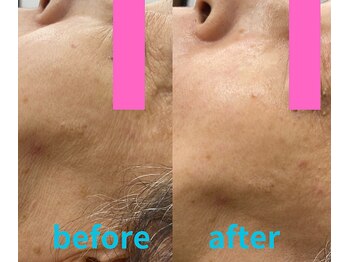 グロワール(gloire)/再生美容2回目(ビフォーアフター