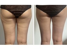 ハイパーナイフ＊痩身/温活/エイジングケア