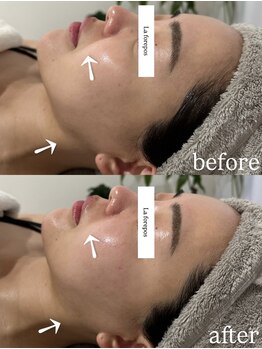 ラ フォルポ 恵比寿(La forepos)/verunaハーブピーリン恵比寿