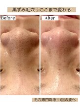 ルアナ 柏店(LUANA)/黒ずみ毛穴洗浄変化例