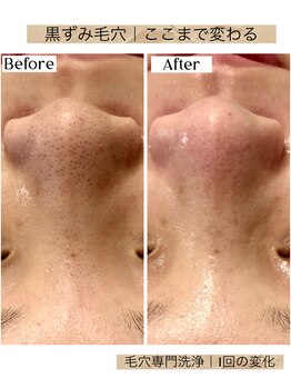 ルアナ 柏店(LUANA)/黒ずみ毛穴洗浄変化例