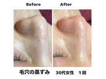 ラナン パラフューズ(Ranun's PARAFUSE.)/毛穴ビフォーアフター（3）