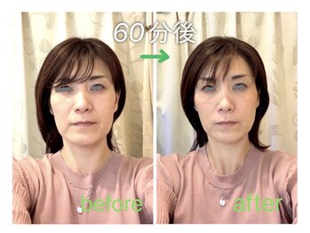 ぷらっと鍼灸院の写真/1回でも変化を実感、小顔と肌の違いが見える美容鍼ケア