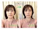 ぷらっと鍼灸院の写真/1回でも変化を実感、小顔と肌の違いが見える美容鍼ケア