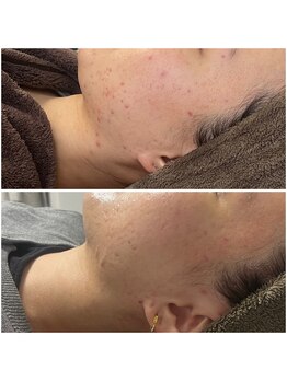 モア(moa)/ハーブピーリング5回目