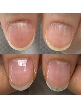 ハッチネイル(HACCI nail)/お客様　before after5か月