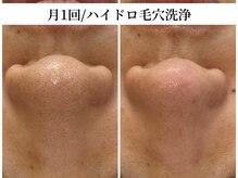 トリニエンス 南流山店/30代/ハイドロ毛穴洗浄