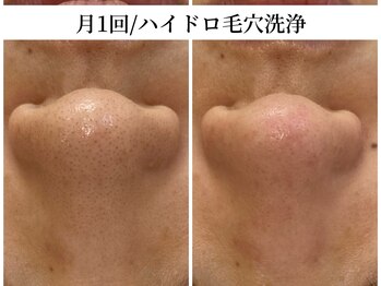 トリニエンス 南流山店/30代/ハイドロ毛穴洗浄