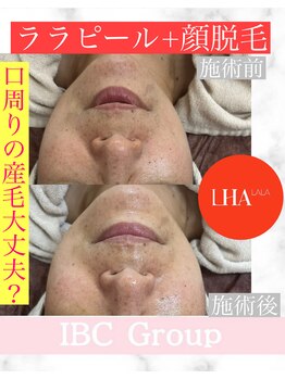 トータルサロンアイビーシー(トータルサロンIBC)/ララピール+お顔脱毛で口髭撲滅