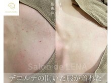 サロン ド レナ(Salon de LENA)/ハーブピーリング サロンドレナ