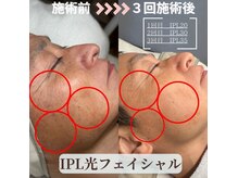 セレステ(Sereste)の雰囲気(大人気IPL光フェイシャル!よりお試ししやすい特別価格に!!)