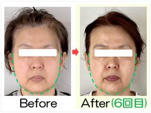 小顔矯正エステ プリュムレーヴ/50代｜たるみがすっきり小顔に