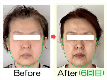 小顔矯正エステ プリュムレーヴ/50代｜たるみがすっきり小顔に