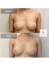 パピヨン(Papillon)/バストアップ