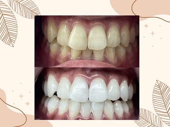 ホワイト つくば店(WHITE)/【6トーンup】初回照射のお客様