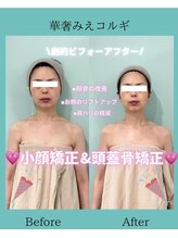 アコガレコガオ 鳥取店/コルギのビフォーアフター