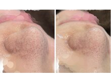 ベル 京都(Belle)/小鼻洗浄Before/After