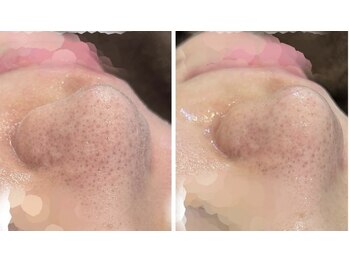 ベル 京都(Belle)/小鼻洗浄Before/After