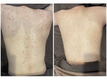 ミラヴィエ(Miravie)/背中重度ニキビ、10代の方