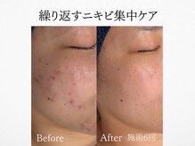 アンドミルル(and Milulu)/【繰り返すニキビ集中ケア】