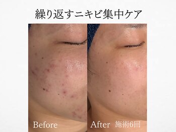 アンドミルル(and Milulu)/【繰り返すニキビ集中ケア】