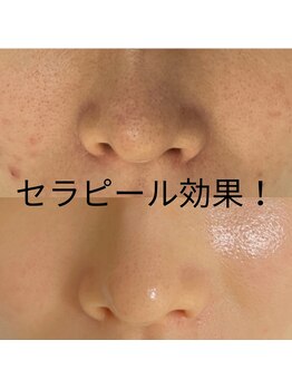 ポリー(Polly)の写真/肌別ピーリング/脱毛しながら美肌もGET！顔脱毛＋で美白シミシワ毛穴悩みを解消［ピーリング/毛穴］