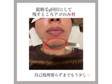 オークツリー(oak tree)/魅せる髭脱毛