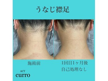 アクト クロ(ACT curro)/【うなじ襟足】施術例