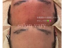 サロンヴェアリー 広尾(salon vary)/赤みくすみ鎮静ケアで人気です。