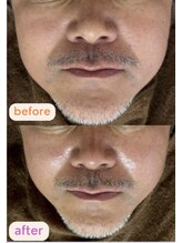 サクラ(SAKURA)/浮腫みに小顔矯正♪