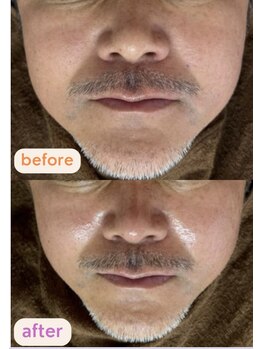 サクラ(SAKURA)/浮腫みに小顔矯正♪