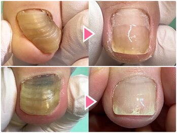 巻き爪補正店 大曽根店/【変形爪/分厚い爪 再生補正】