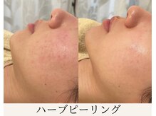 ミウ(MIU)/【 ハーブピーリング 】