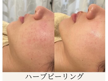 ミウ(MIU)/【 ハーブピーリング 】