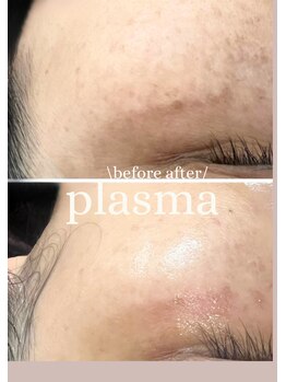 ビー ブルーム(B BLOOM)/【プラズマシミケア】